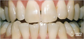 Dentition avant blanchiment dentaire Dentition avant blanchiment dentaire