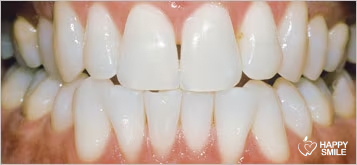 Dentition après blanchiment dentaire Dentition après blanchiment dentaire