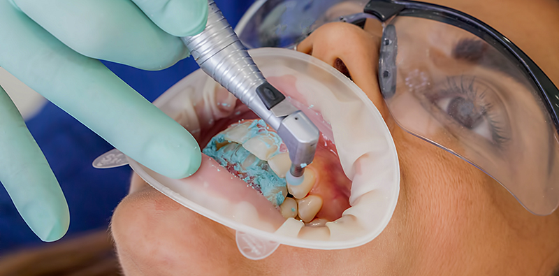 fluorose_dentaire_microabrasion détartrage et polissage