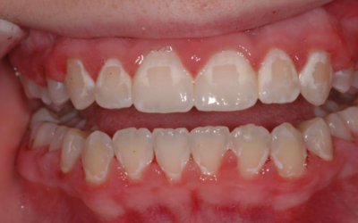 Taches Blanches sur les Dents : Causes, Traitements et Prévention
