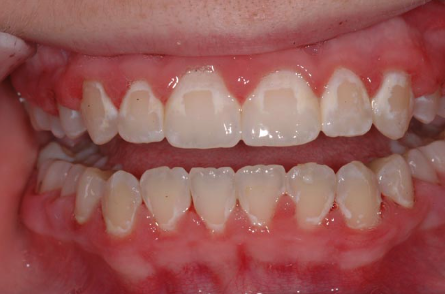 Taches Blanches sur les Dents : Causes, Traitements et Prévention